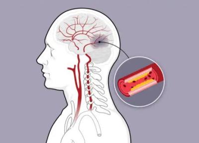 احتمال ابتلای چه کسانی به سکته مغزی بیشتر است؟